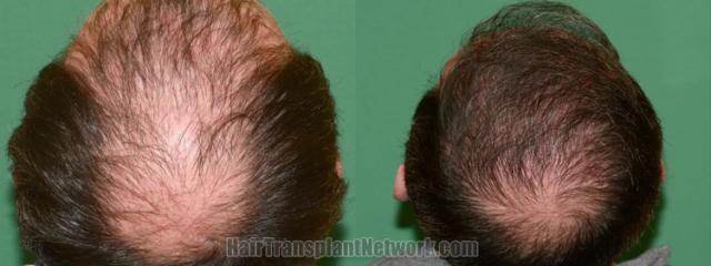 Back view before and after hair transplantation 