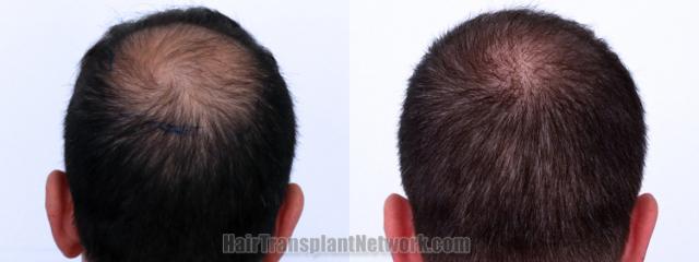 Back view before and after hair transplantation 