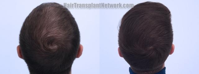 Back view before and after hair transplantation 