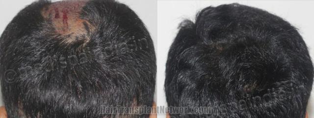 Back view before and after hair transplantation 