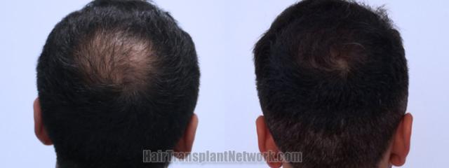 Back view before and after hair transplantation 