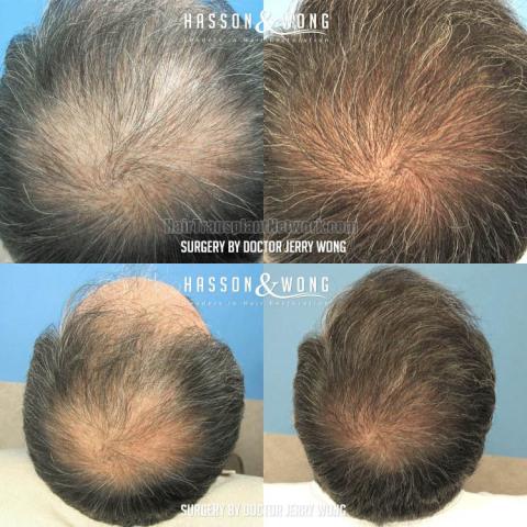 Surgical hair transplantation result photographs