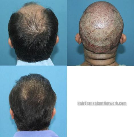 Surgical hair transplantation result photographs