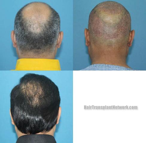 Surgical hair transplantation result photographs