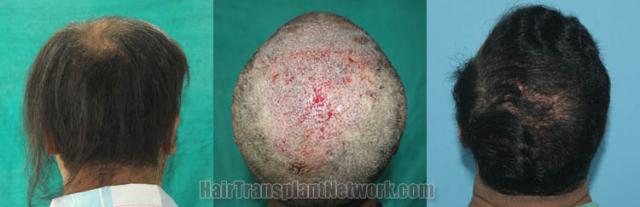 Surgical hair transplantation result photographs