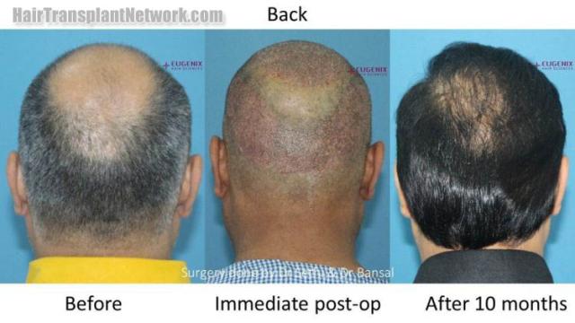 Surgical hair transplantation result photographs