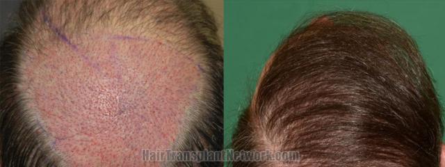 Back view before and after hair transplantation photos