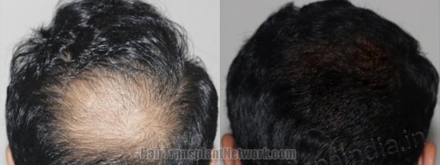 Back view before and after hair transplantation 