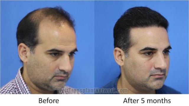 Hair transplantation procedure before and after results