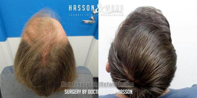 Surgical hair transplantation result photographs