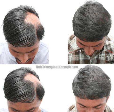 Hair restoration procedure before and after results