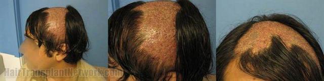 Before and after photos of a burns victims hair transplant