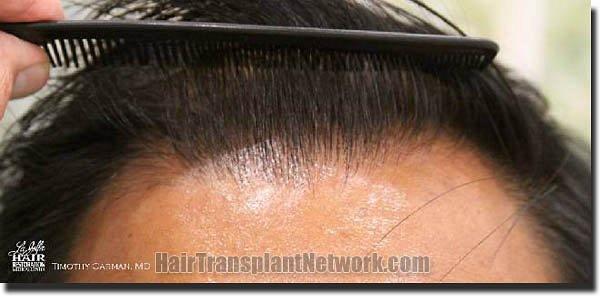 Hair restoration procedure results