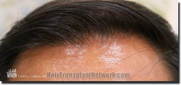 Hair restoration procedure results