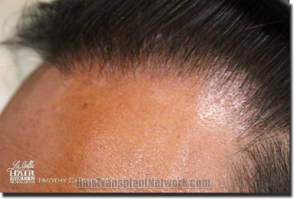 Hair restoration procedure results