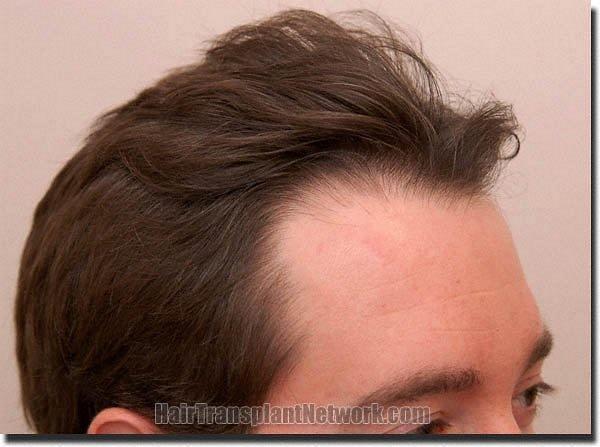 Hair restoration procedure results