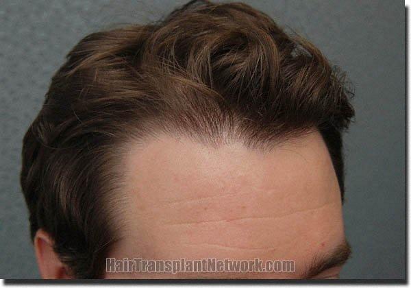 Hair restoration procedure results