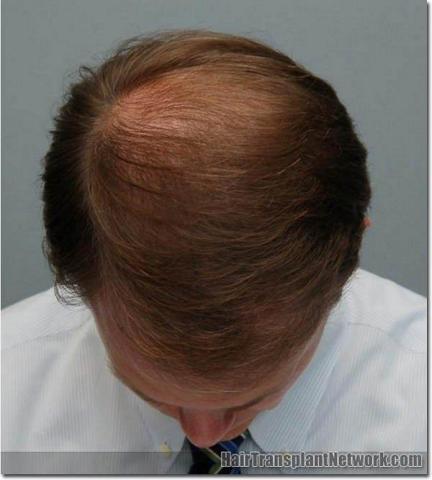 Hair restoration procedure results