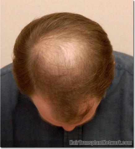 Hair restoration procedure results