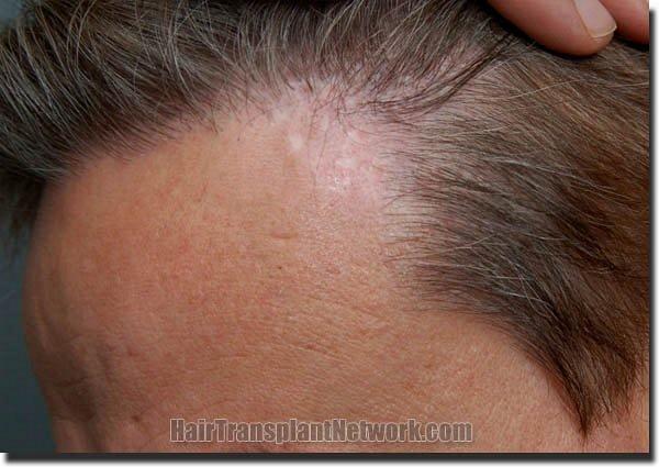 Hair restoration procedure results