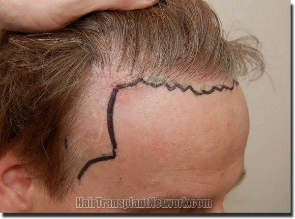 Hair restoration procedure results