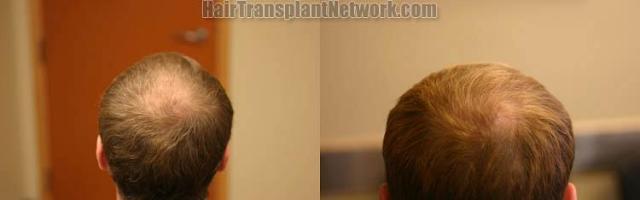 Hair transplantation surgery before and after pictures