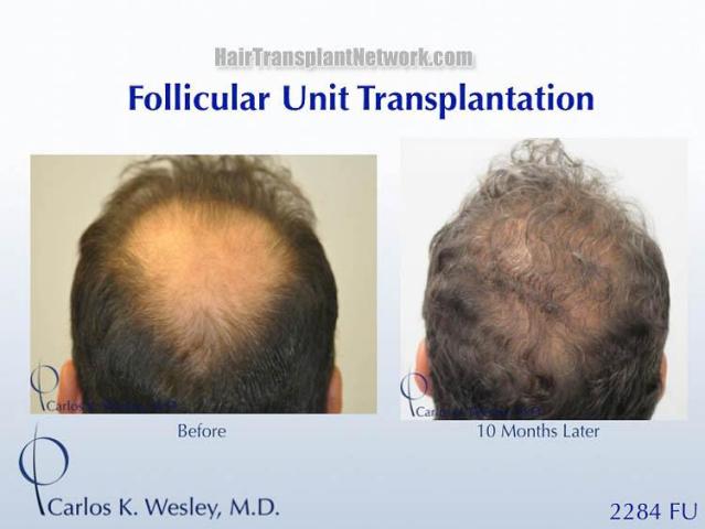 Hair restoration procedure before and after results