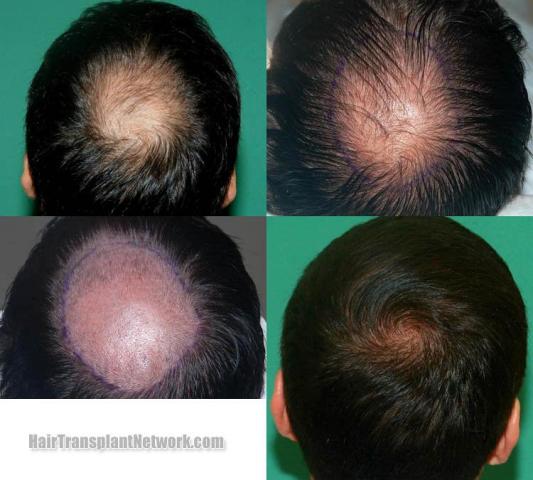 Hair restoration procedure before and after pictures