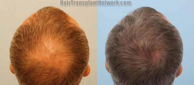 Before and after hair transplantation result photographs