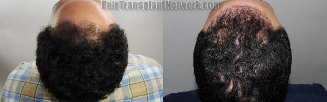 Hair restoration procedure before and after pictures