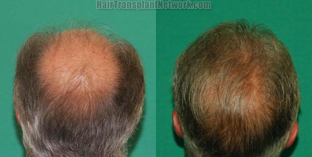 Hair transplantation procedure before and after photographs