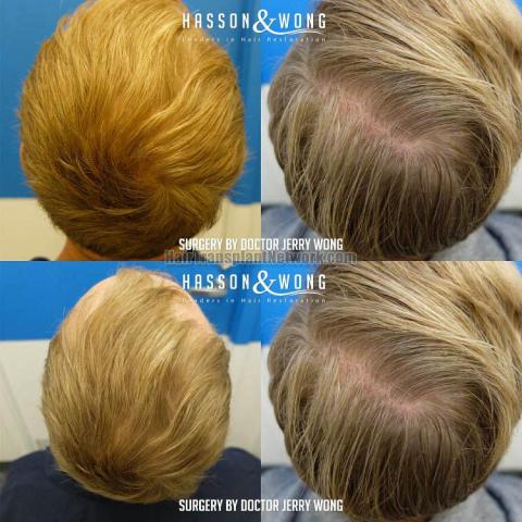 Hair replacement surgery before and after images