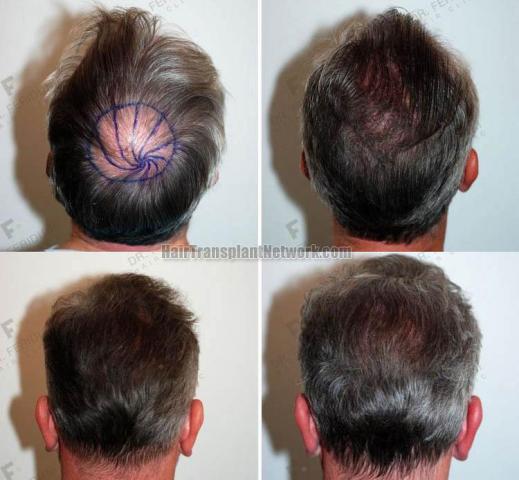 Surgical hair transplantation result photographs