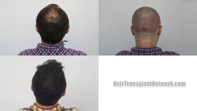 Surgical hair transplantation result photographs