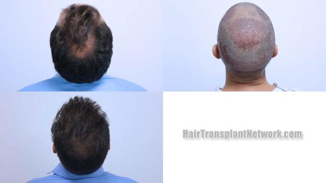 Surgical hair transplantation result photographs