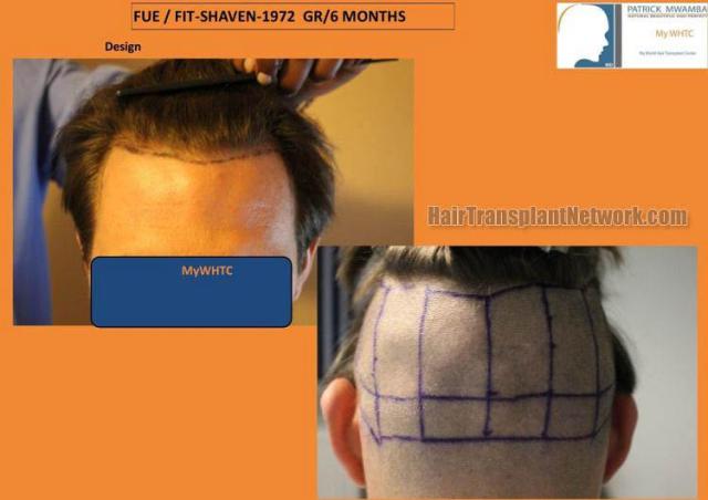 Hair transplant surgery before and after photos