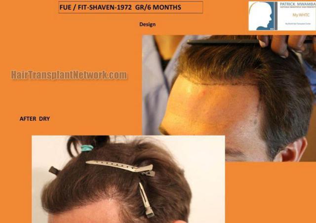 Hair restoration procedure before and after results