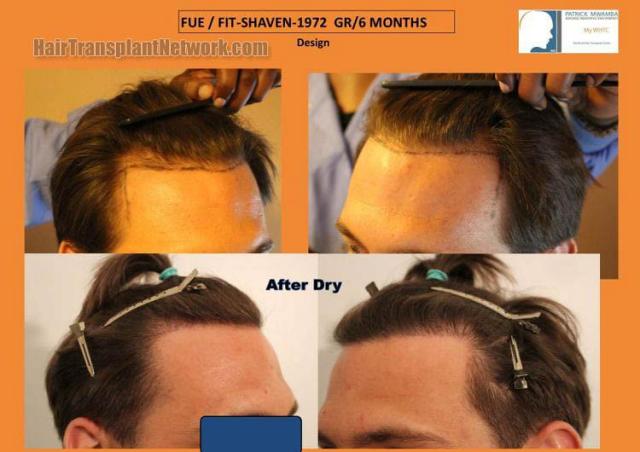 Hair restoration procedure before and after results