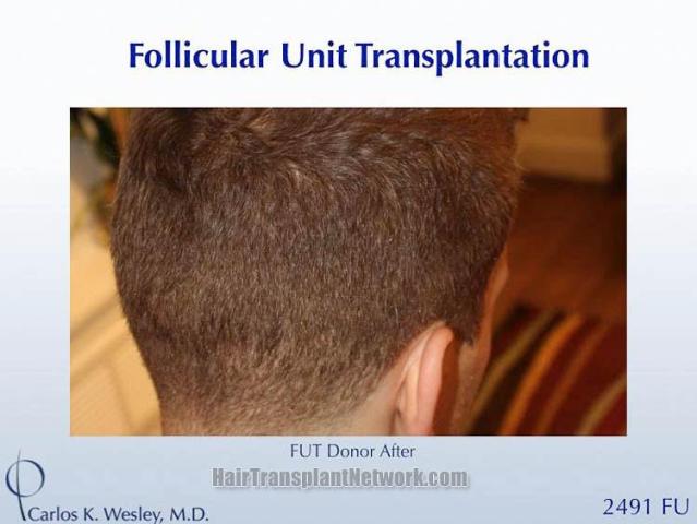 Surgical hair transplantation result photographs