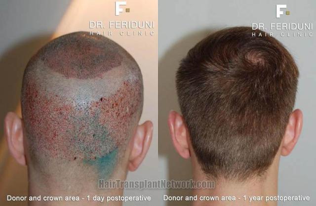 Hair transplantation surgery before and after images