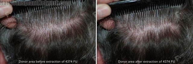 Hair restoration procedure before and after result images