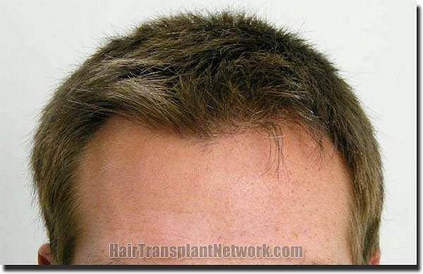 Hair restoration procedure results