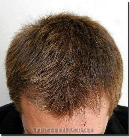 Hair restoration procedure results