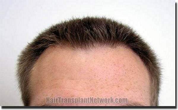 Hair restoration procedure results