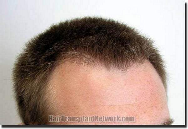 Hair restoration procedure results