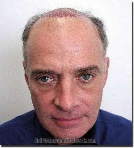 Hair restoration procedure results