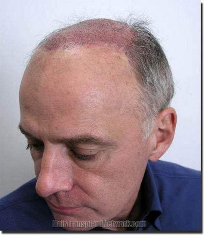 Hair restoration procedure results