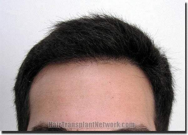 Hair restoration procedure results