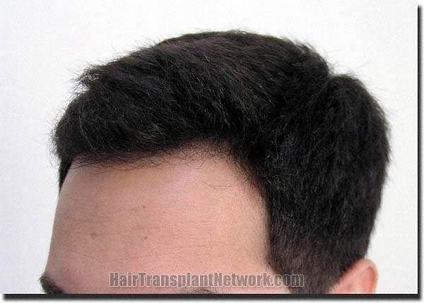 Hair restoration procedure results