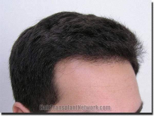 Hair restoration procedure results